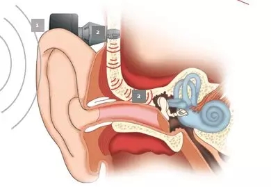 夏寅：骨锚式听觉植入技术（BAHA）